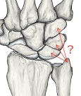 从后面看右腕，箭头示尺腕背侧韧带的大致走行。