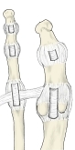 跖趾关节，标出侧副韧带、跖板、关节囊和跖骨深横韧带的名称。